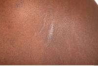 human skin scars 0001